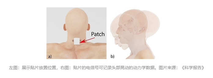 新型可穿戴傳感器能檢測潛在腦震蕩